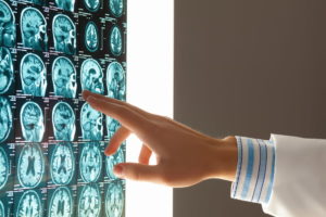 Attorney for brain injuries in Ohio